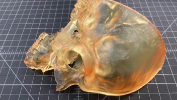Surgical Planning Skull